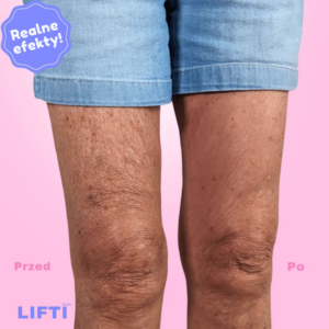 LIFTI- niewidzialny lifting ciała